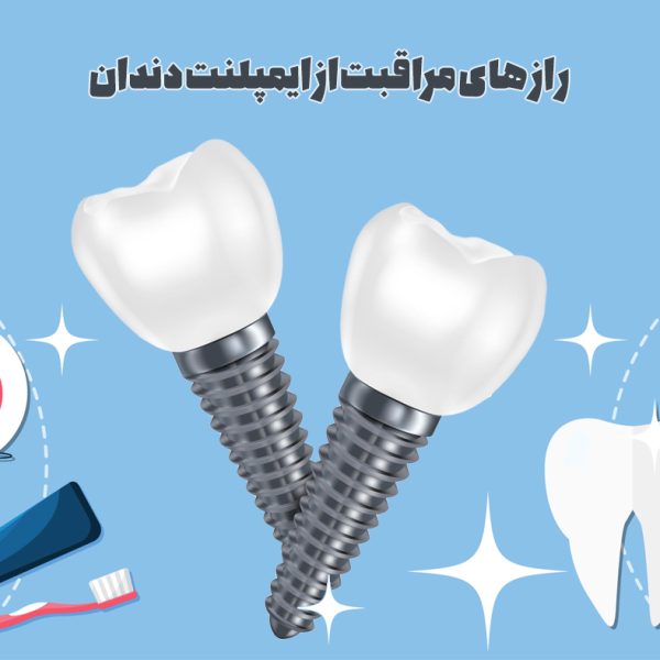 طول عمر ایمپلنت دندان با رعایت بهداشت دهان و دندان و مراقبت از ایمپلنت دندان در تبریز