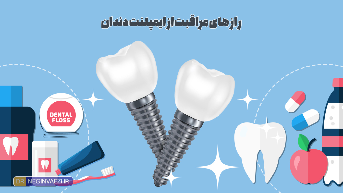 طول عمر ایمپلنت دندان با رعایت بهداشت دهان و دندان و مراقبت از ایمپلنت دندان در تبریز