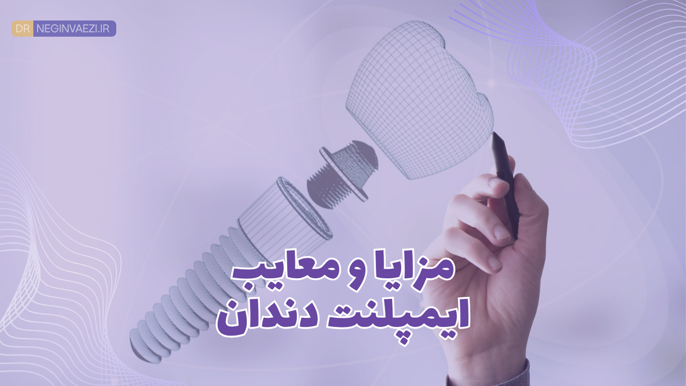 بررسی مزایا و معایب ایمپلنت دندان در بیماران مختلف و مقایسه با بریج و روکش توسط دکتر نگین واعظی در تبریز