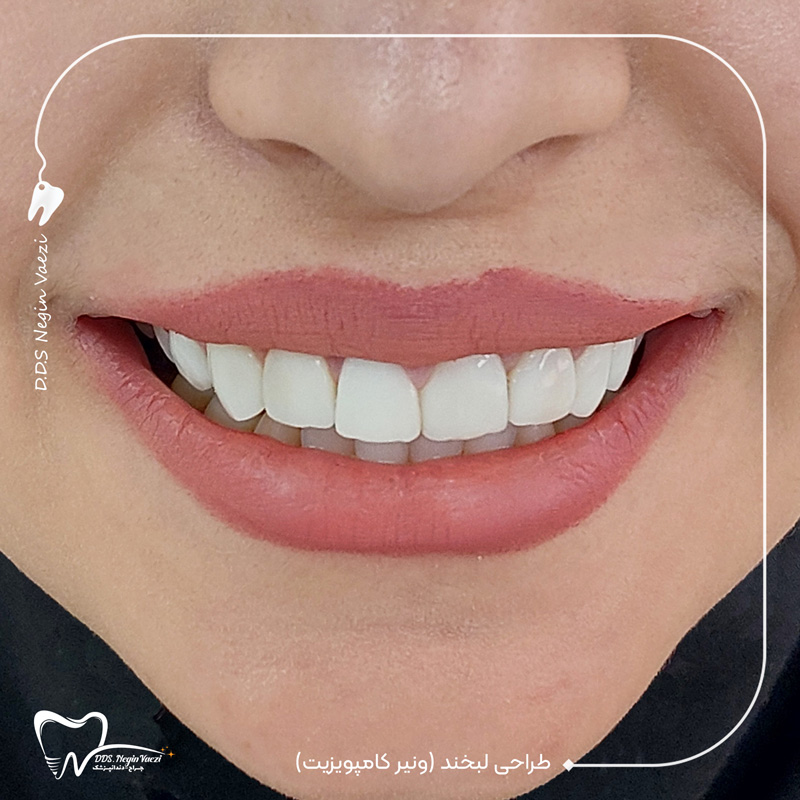نمونه کار بعد از ونیر کامپوزیتی دندان در تبریز توسط دکتر نگین واعظی ولیعصر