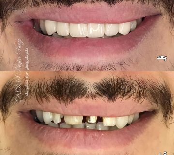 نمونه کار روکش سرامیکی دندان در تبریز با روکش های زیرکونیم یا زیرکونیا توسط دکتر نگین واعظی ولیعصر