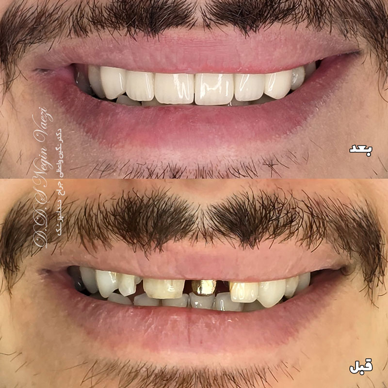 نمونه کار روکش سرامیکی دندان در تبریز با روکش های زیرکونیم یا زیرکونیا توسط دکتر نگین واعظی ولیعصر