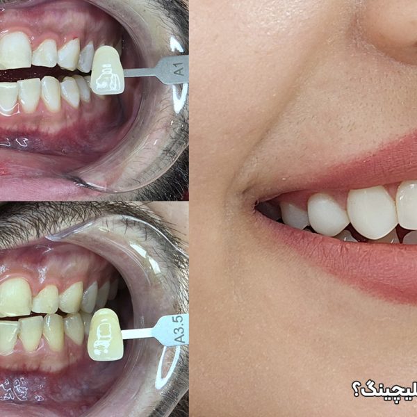 ونیر کامپوزیت یا بلیچینگ دندان در تبریز تفاوت ها و مزایا و معایب توسط دکتر نگین واعظی دندانپزشک زیبایی