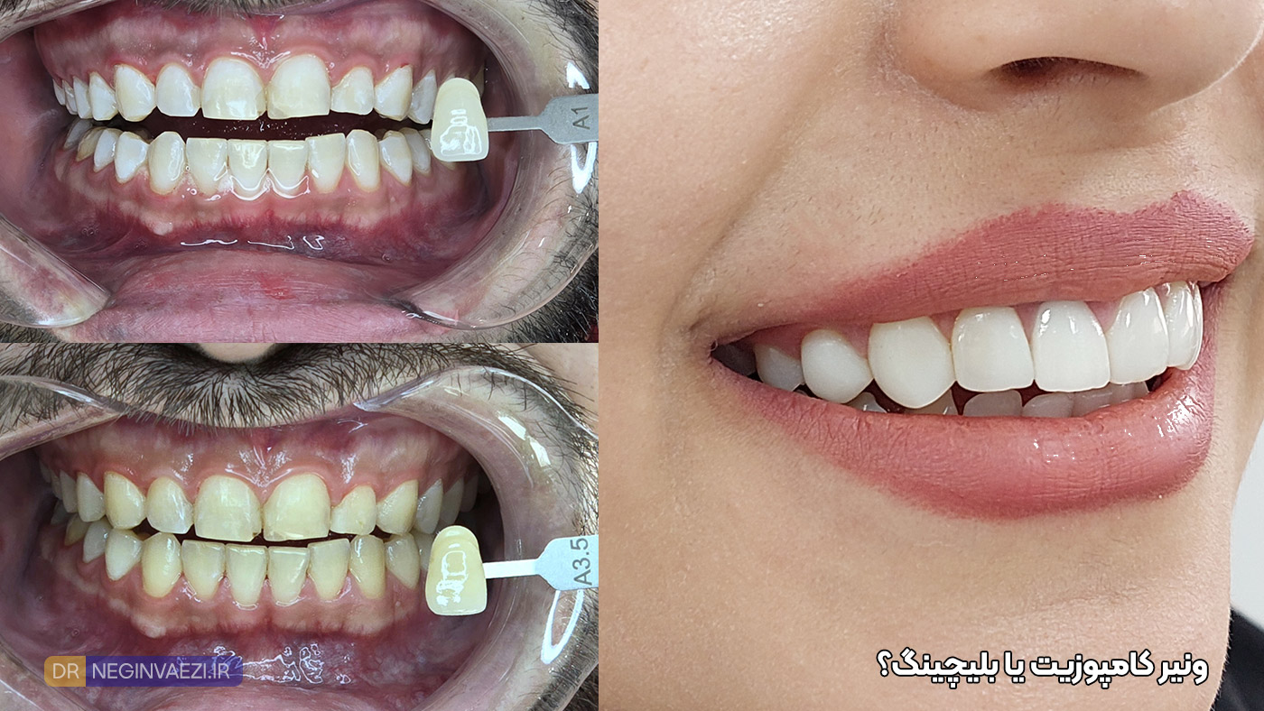 ونیر کامپوزیت یا بلیچینگ دندان در تبریز تفاوت ها و مزایا و معایب توسط دکتر نگین واعظی دندانپزشک زیبایی