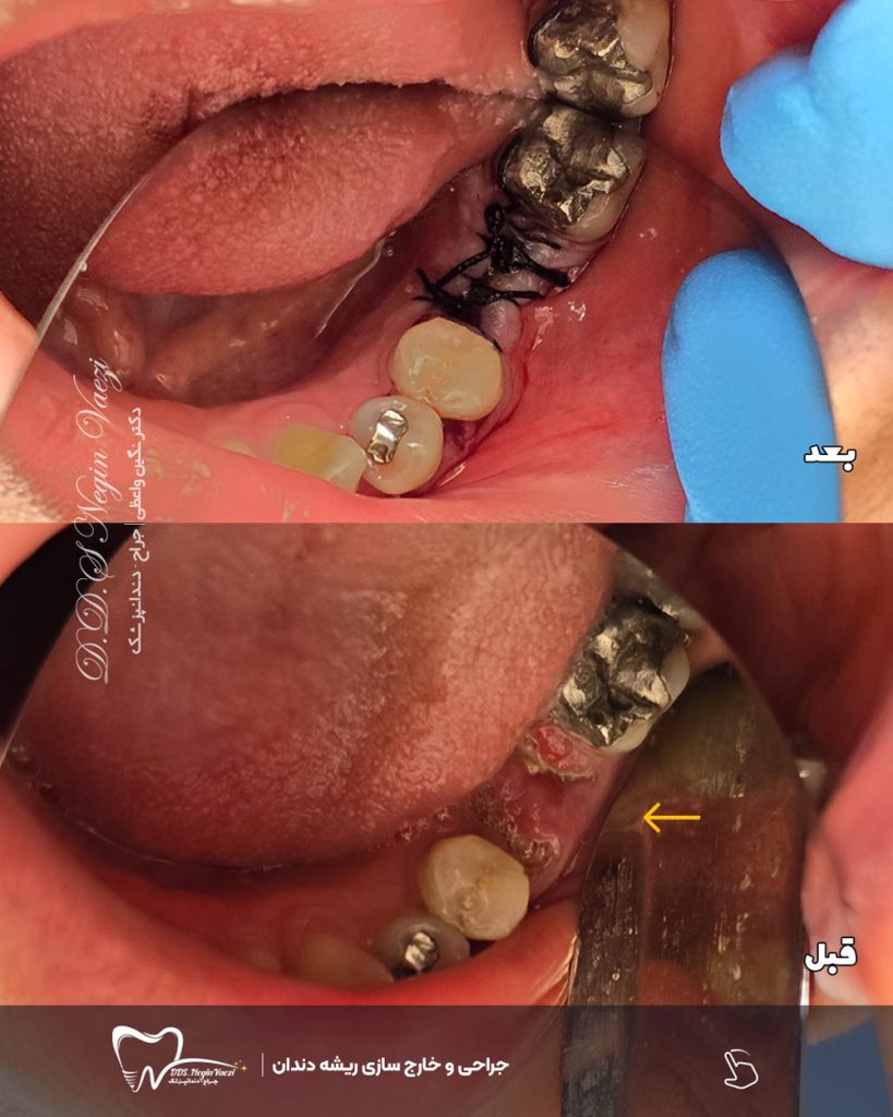 عکس قبل و بعد جراحی خارج سازی ریشه باقیمانده غیر قابل نگهداری دندان در تبریز توسط دکتر نگین واعظی
