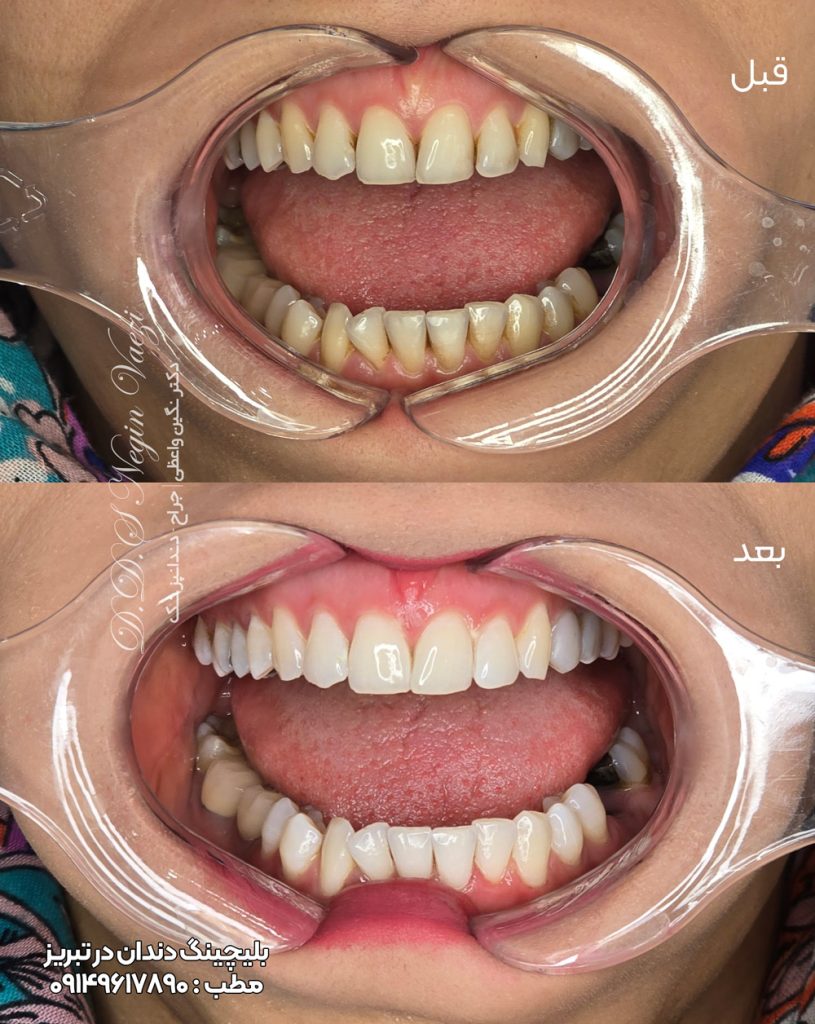 نمونه کار بلیچینگ تبریز 815x1024