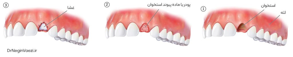 پیوند استخوان دندان برای ایمپلنت دندان در تبریز در مطب دکتر نگین واعظی