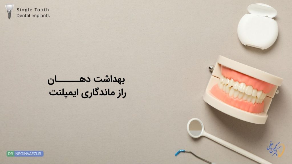 مراقبت های بعد از کاشت ایمپلنت تکی دندان در تبریز - دکتر نگین واعظی ولیعصر تبریز