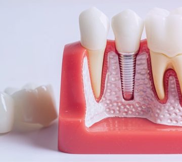 ایمپلنت یک دندان در تبریز؛ کاشت ایمپلنت تک دندانی جلو و عقب توسط دکتر نگین واعظی ولیعصر
