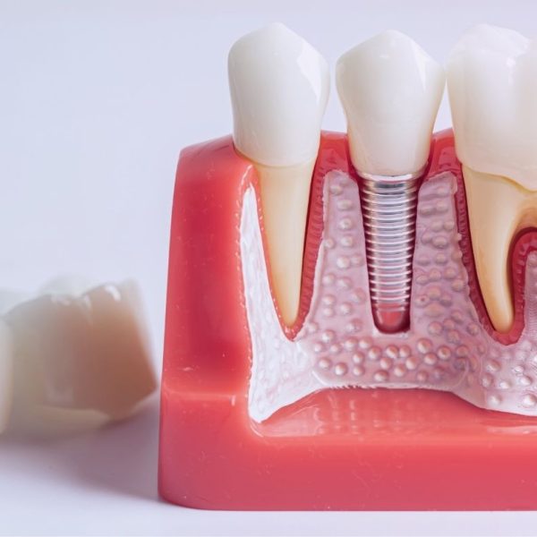 ایمپلنت یک دندان در تبریز؛ کاشت ایمپلنت تک دندانی جلو و عقب توسط دکتر نگین واعظی ولیعصر