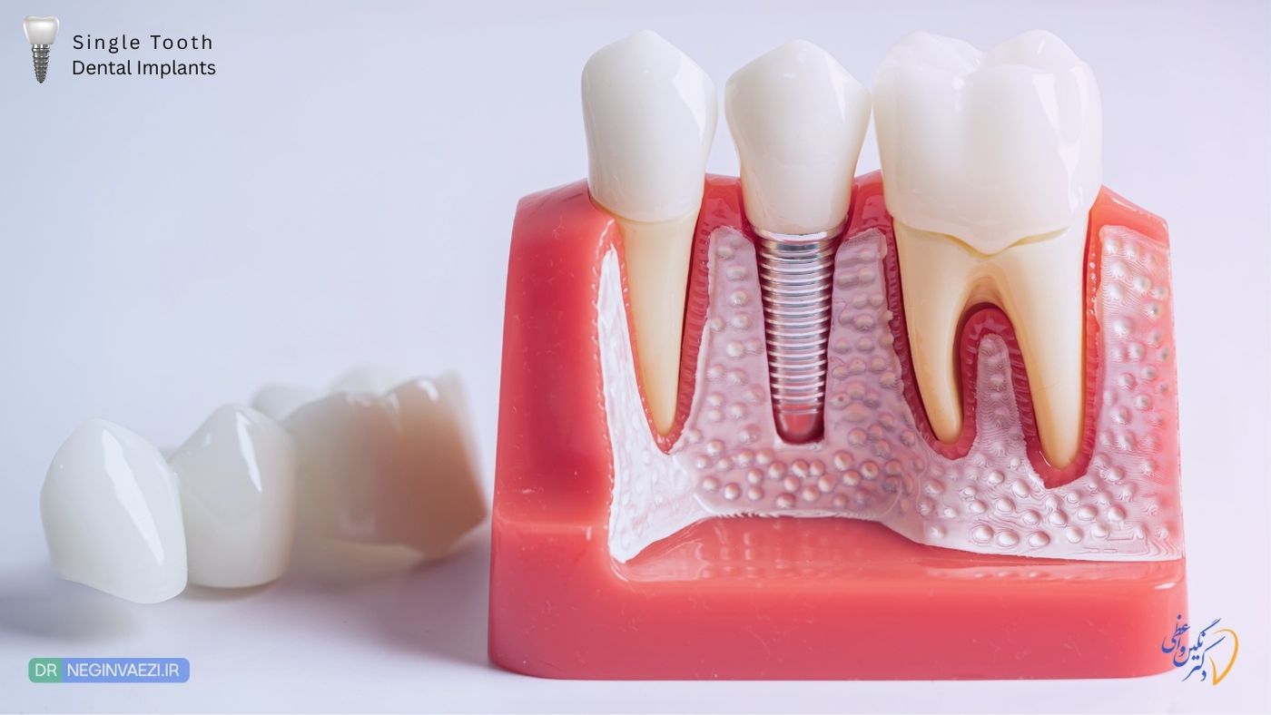 ایمپلنت یک دندان در تبریز؛ کاشت ایمپلنت تک دندانی جلو و عقب توسط دکتر نگین واعظی ولیعصر