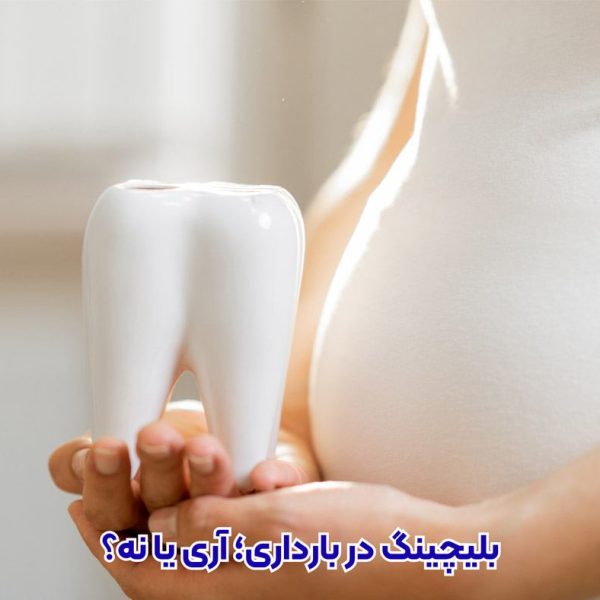 بلیچینگ دندان در بارداری و شیردهی خطرناک است؟ پاسخ از دکتر نگین واعظی دندانپزشک در تبریز