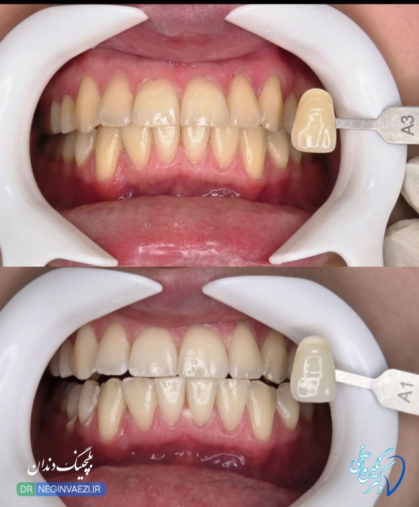 نمونه کار قبل و بعد بلیچینگ دندان در تبریز توسط دکتر نگین واعظی