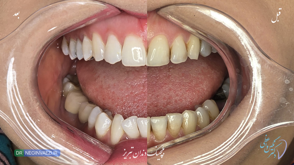 بلیچینگ دندان چقدر دوام دارد ؟عکس بلیچینگ دندان تبریز در مطب دکتر نگین واعظی