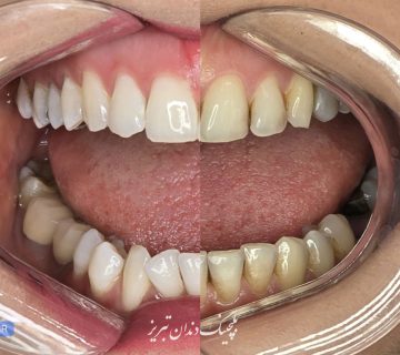 بلیچینگ دندان چقدر دوام دارد؟ عوامل موثر در ماندگاری و دوام سفید کردن دندان ها در تبریز