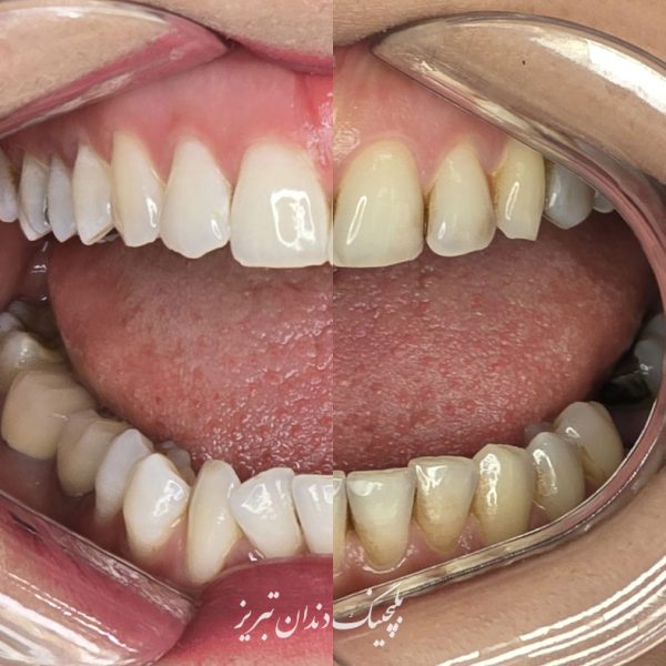 بلیچینگ دندان چقدر دوام دارد؟ عوامل موثر در ماندگاری و دوام سفید کردن دندان ها در تبریز