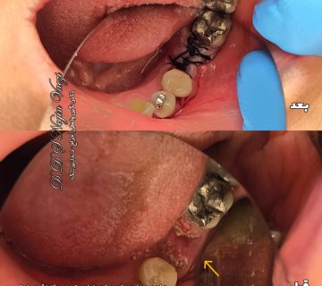 عکس قبل و بعد نمونه کار جراحی و خارج سازی ریشه باقیمانده دندان غیر قابل نگهداری در تبریز توسط دکتر نگین واعظی در مطب ولیعصر