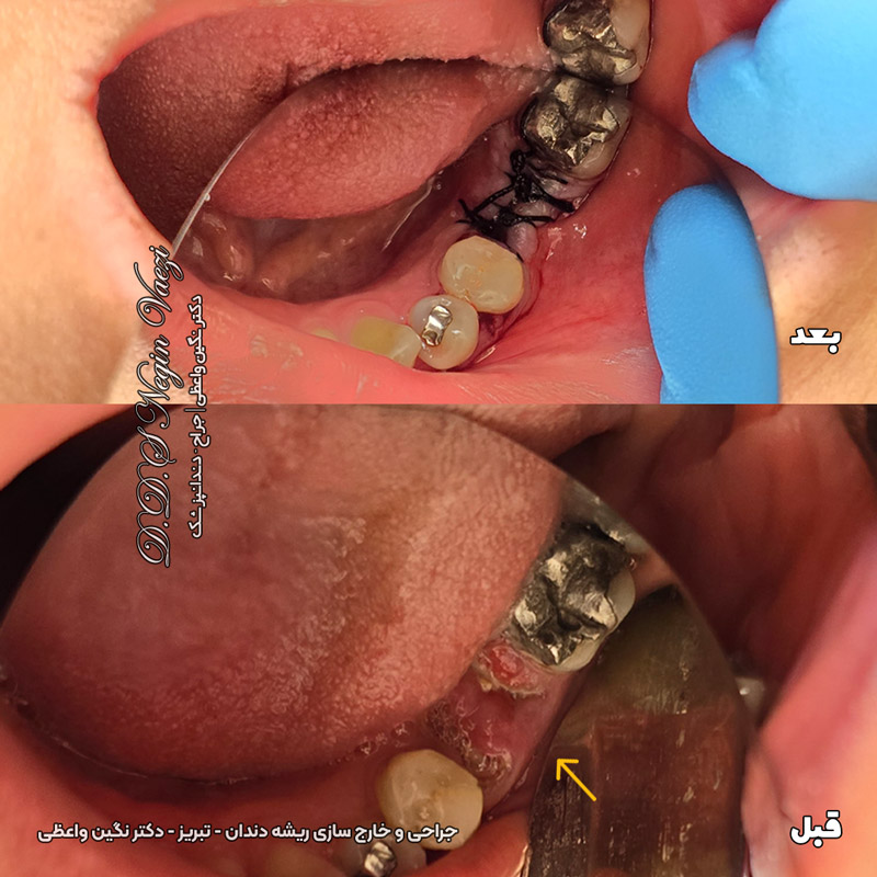 عکس قبل و بعد نمونه کار جراحی و خارج سازی ریشه باقیمانده دندان غیر قابل نگهداری در تبریز توسط دکتر نگین واعظی در مطب ولیعصر