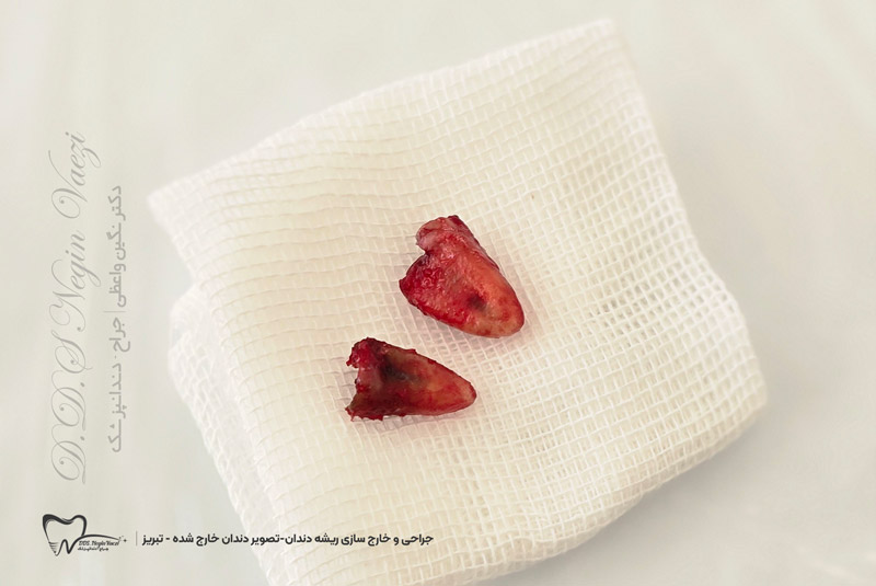 عکس واقعی ریشه های دندانی خارج شده بعد از جراحی دندان در تبریز توسط دکتر نگین واعظی در مطب ولیعصر