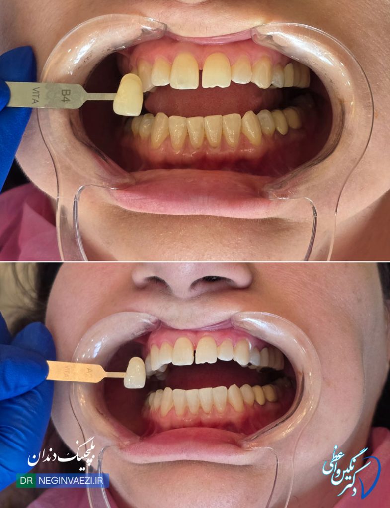 میزان تغییر رنگ دندان و سفید شدن بعد از بلیچینگ - دکتر نگین واعظی تبریز