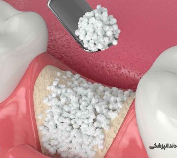 پیوند استخوان برای ایمپلنت دندان در تبریز همراه با مراحل و هزینه انجام در مطب دکتر نگین واعظی ولیعصر