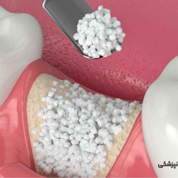 پیوند استخوان برای ایمپلنت دندان در تبریز همراه با مراحل و هزینه انجام در مطب دکتر نگین واعظی ولیعصر