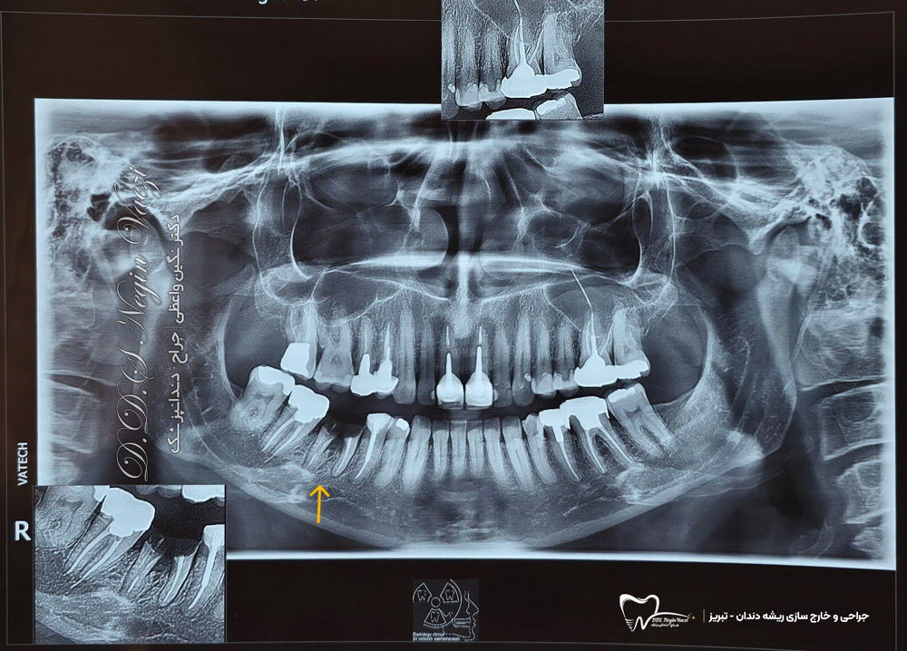 تصویر /عکس رادیوگرافی دندان های غیر قابل نگهداری با ریشه باقیمانده در تبریز توسط دکتر نگین واعظی