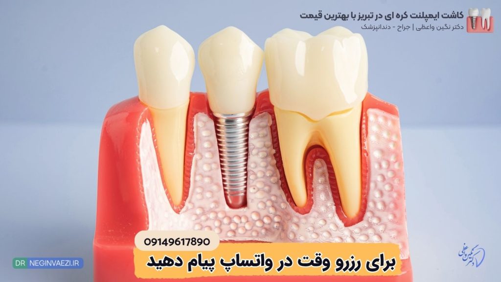 کاشت ایمپلنت کره ای دنتیس و مگاژن در تبریز 1024x576