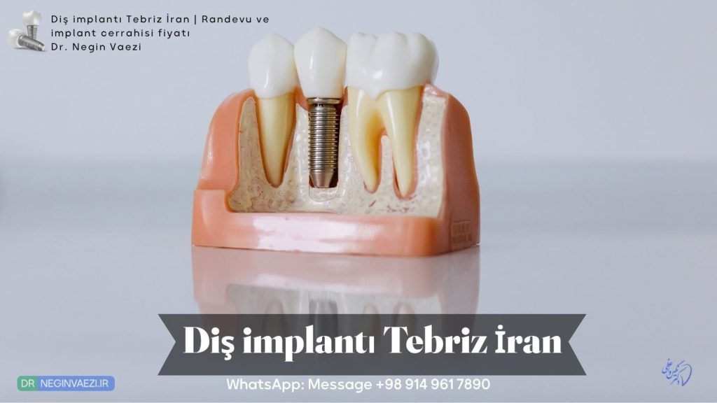 Diş implantı Tebriz İran   Uygun fiyatlı implant tedavisi