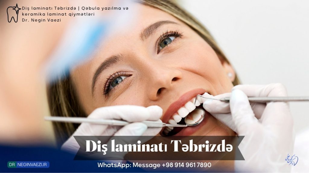 Təbriz diş laminatı   Keramika laminat ilə ağ gülümsəmə