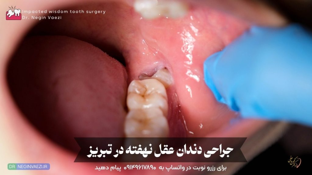 کشیدن و جراحی دندان عقل و عقل نهفته و نیمه نهفته در تبریز ولیعصر دکتر نگین واعظی