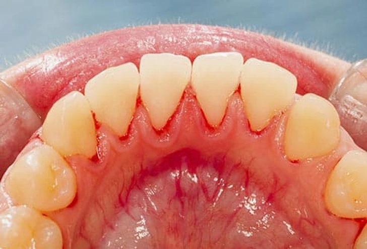 مشکلات لثه و جرم گیری دندان در تبریز