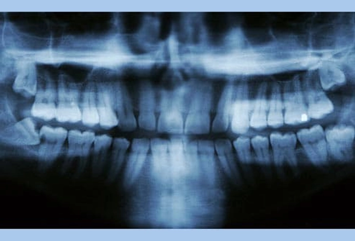 مشکل کشیدن و جراحی دندان عقل در تبریز