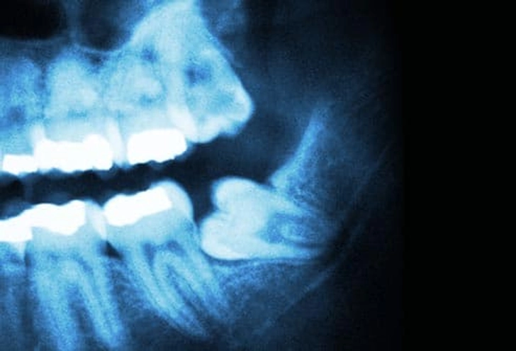 دندان نهفته (Impacted Teeth) در تبریز درمان جراحی توسط دکتر نگین واعظی