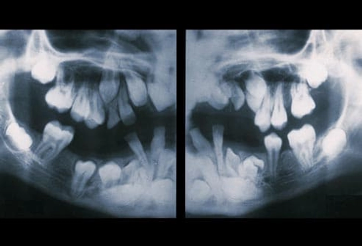 تعداد زیاد دندان‌ها (Hyperdontia)