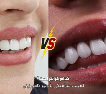 مقایسه قیمت لمینیت سرامیکی و ونیر کامپوزیتی در تبریز در مطب دندانپزشکی زیبایی دکتر نگین واعظی ولیعصر تبریز