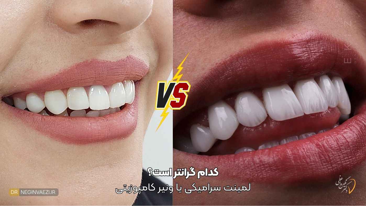 مقایسه قیمت لمینیت سرامیکی و ونیر کامپوزیتی در تبریز در مطب دندانپزشکی زیبایی دکتر نگین واعظی ولیعصر تبریز