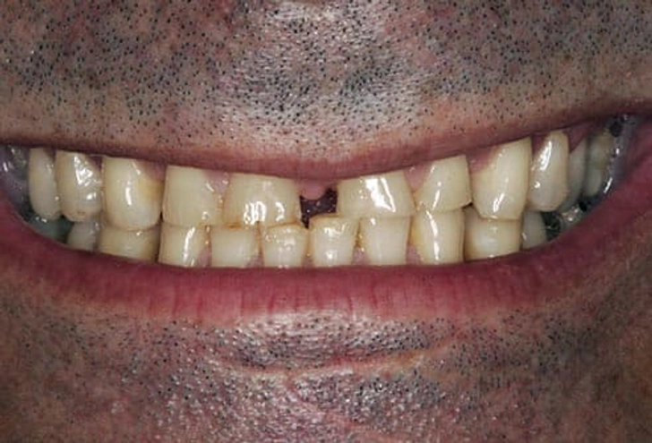 براکسیسم دندان قروچه