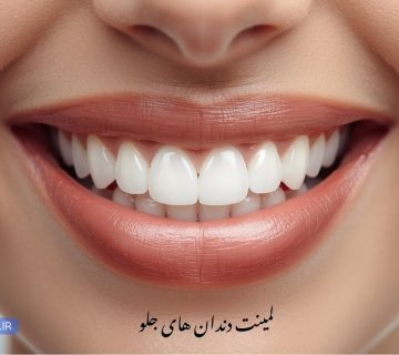 بهترین دندانپزشک لمینت دندان جلو در تبریز - سرامییک و emax