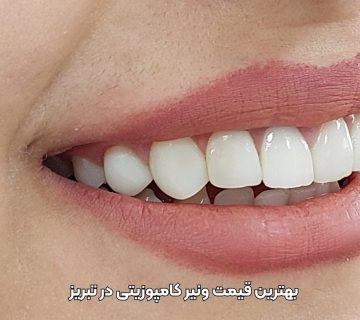 قیمت کامپوزیت دندان در تبریز - قیمت ونیر کامپوزیتی در تبریز مطب دکتر نگین واعظی ولیعصر