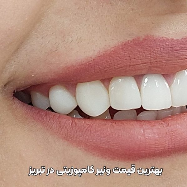 قیمت کامپوزیت دندان در تبریز - قیمت ونیر کامپوزیتی در تبریز مطب دکتر نگین واعظی ولیعصر
