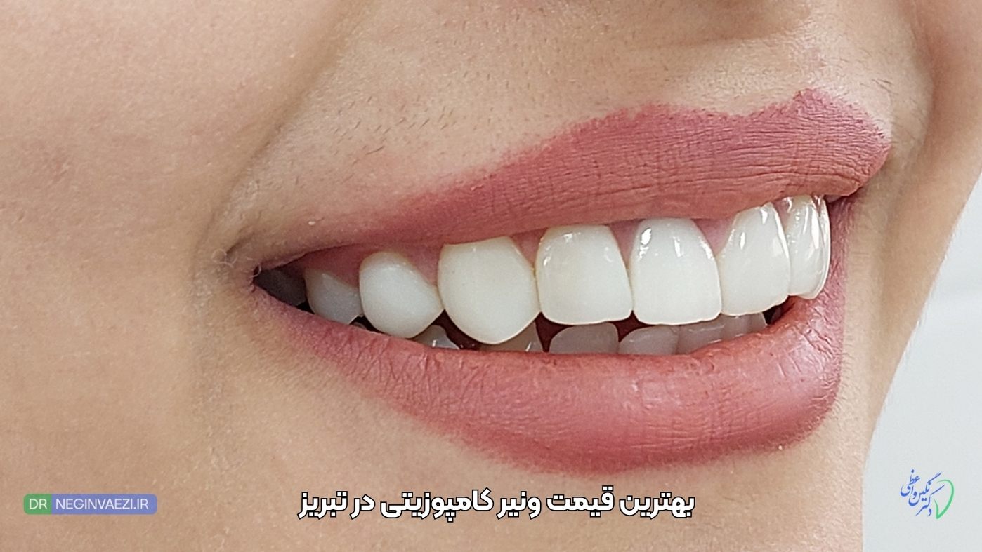 قیمت کامپوزیت دندان در تبریز - قیمت ونیر کامپوزیتی در تبریز مطب دکتر نگین واعظی ولیعصر