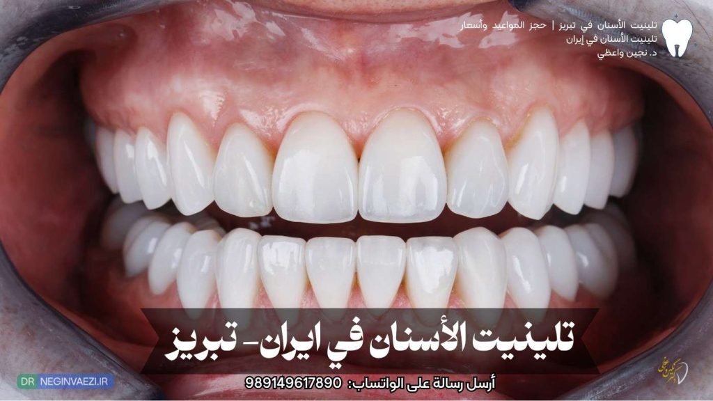 تلينيت الأسنان في إيران تبريز – ابتسامة طبيعية وجميلة الدکتره نجین واعظی