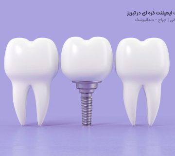 بهترین قیمت ایمپلنت کره ای در تبریز مطب دکتر نگین واعظی ولیعصر برای دنتیس و مگاژن