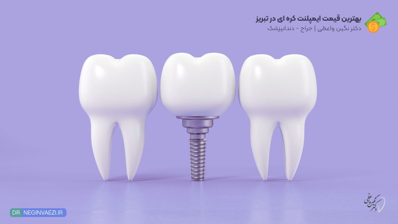 بهترین قیمت ایمپلنت کره ای در تبریز مطب دکتر نگین واعظی ولیعصر برای دنتیس و مگاژن