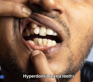 هایپردنتیا چیست؟Hyperdentia یا extra teeth علل و روش های تشخیص و درمان و کشیدن دندان های اضافی