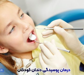 بهترین روشهای درمان پوسیدگی دندان کودکان | پیشگیری، فلوراید، سیلنت و پرکردن