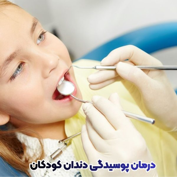 بهترین روشهای درمان پوسیدگی دندان کودکان | پیشگیری، فلوراید، سیلنت و پرکردن