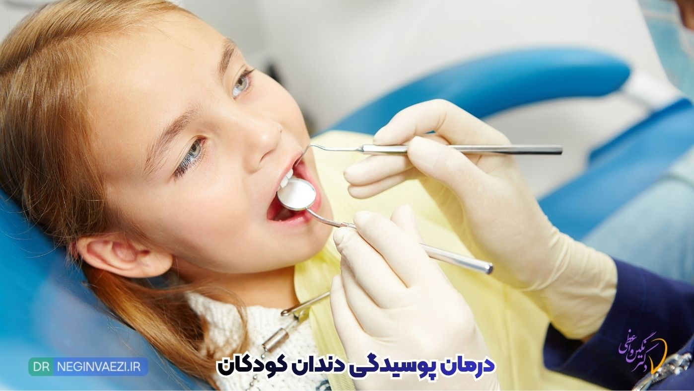 بهترین روشهای درمان پوسیدگی دندان کودکان | پیشگیری، فلوراید، سیلنت و پرکردن