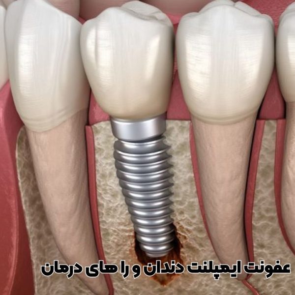 عفونت ایمپلنت دندان، از کجا بفهمیم ایمپلنت عفونت کرده است,جلوگیری از عفونت ایمپلنت دندان
